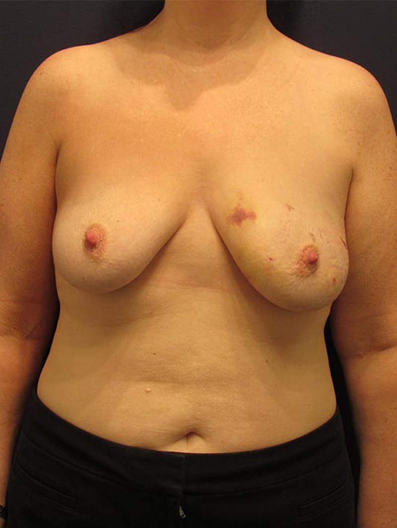 Breast Reconstruction Before & After Gallery - Patient 174164419 - Image 1