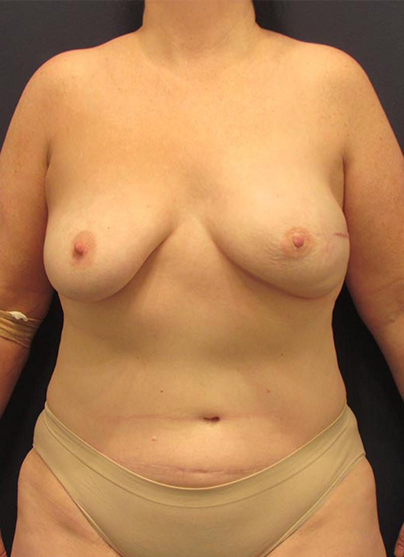 Breast Reconstruction Before & After Gallery - Patient 174164419 - Image 2