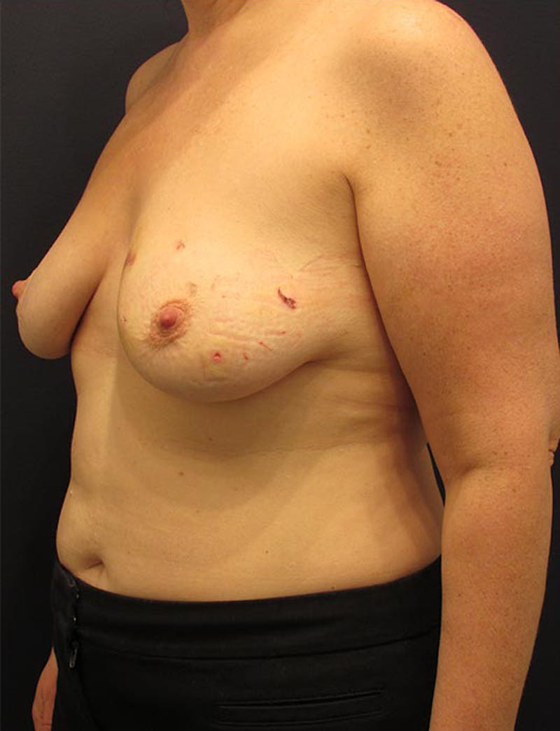 Breast Reconstruction Before & After Gallery - Patient 174164419 - Image 3