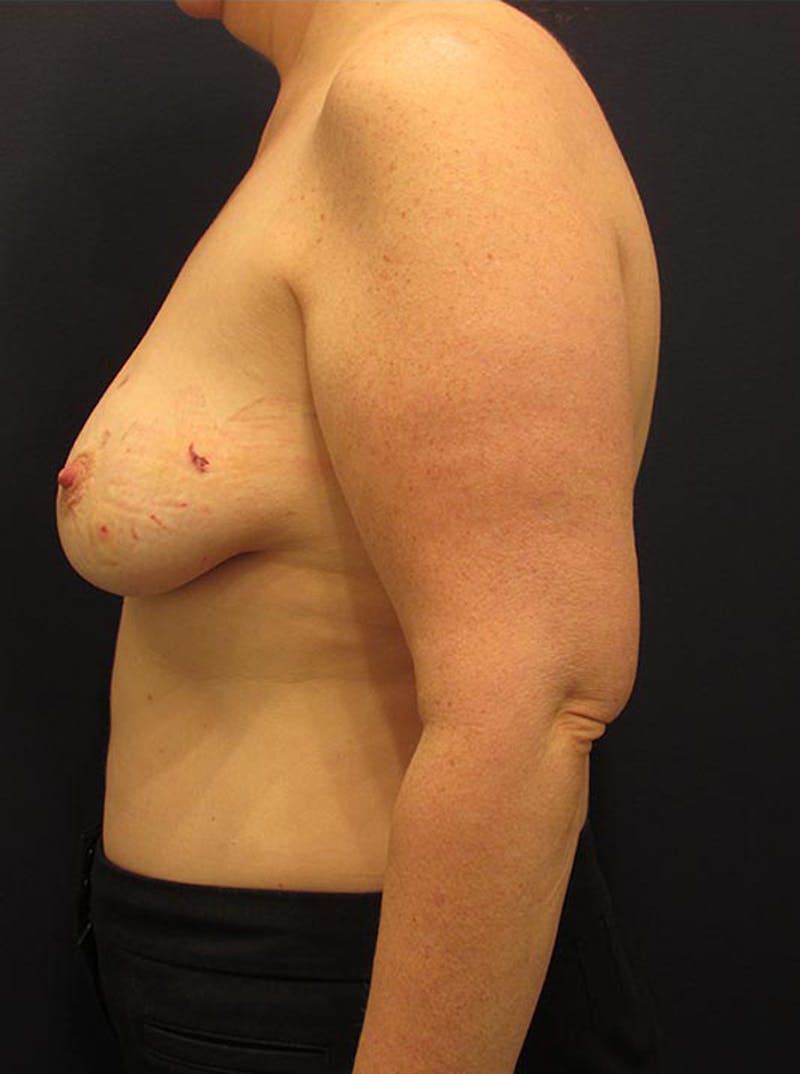 Breast Reconstruction Before & After Gallery - Patient 174164419 - Image 5