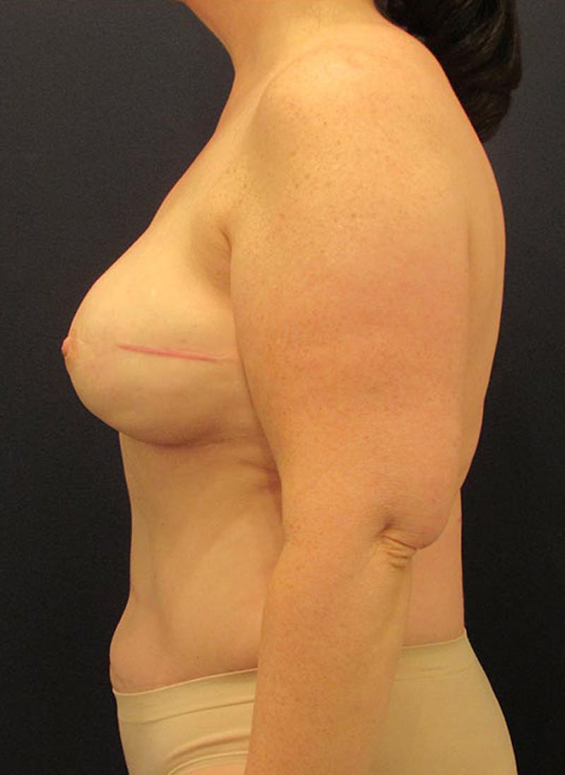 Breast Reconstruction Before & After Gallery - Patient 174164419 - Image 6