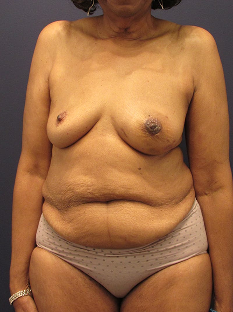 Breast Reconstruction Before & After Gallery - Patient 174164434 - Image 1