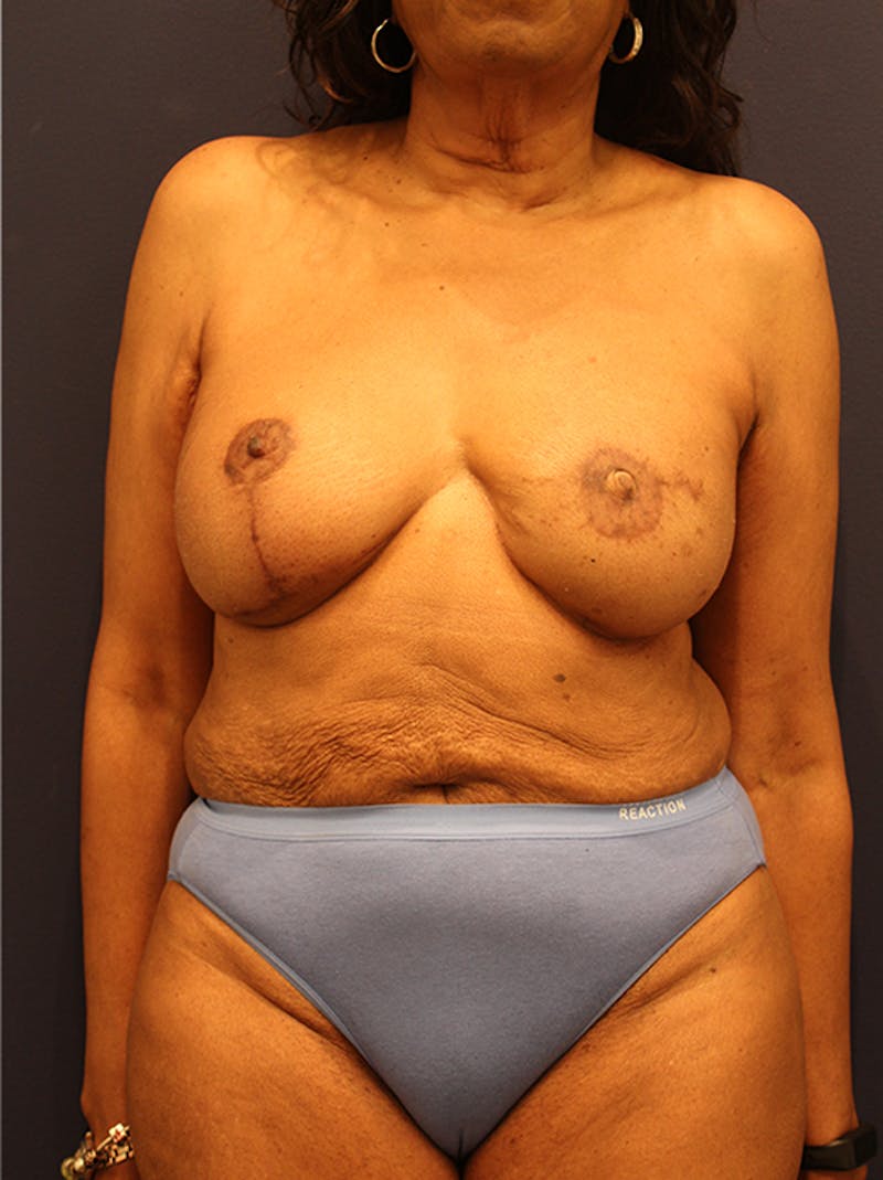 Breast Reconstruction Before & After Gallery - Patient 174164434 - Image 2