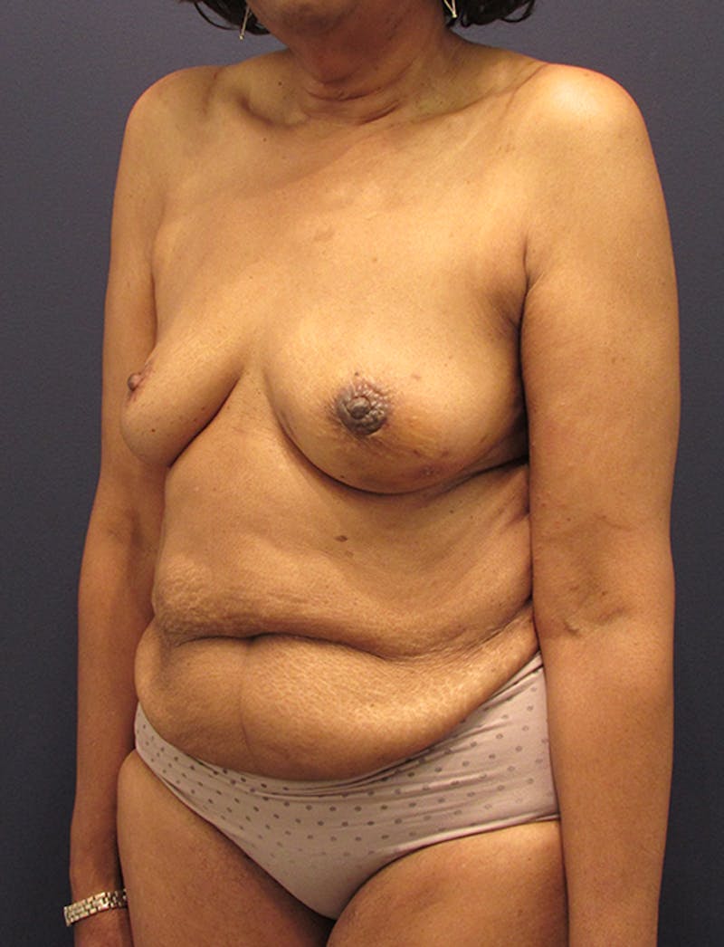 Breast Reconstruction Before & After Gallery - Patient 174164434 - Image 3