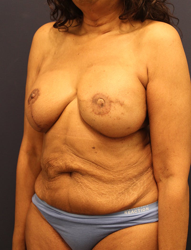 Breast Reconstruction Before & After Gallery - Patient 174164434 - Image 4