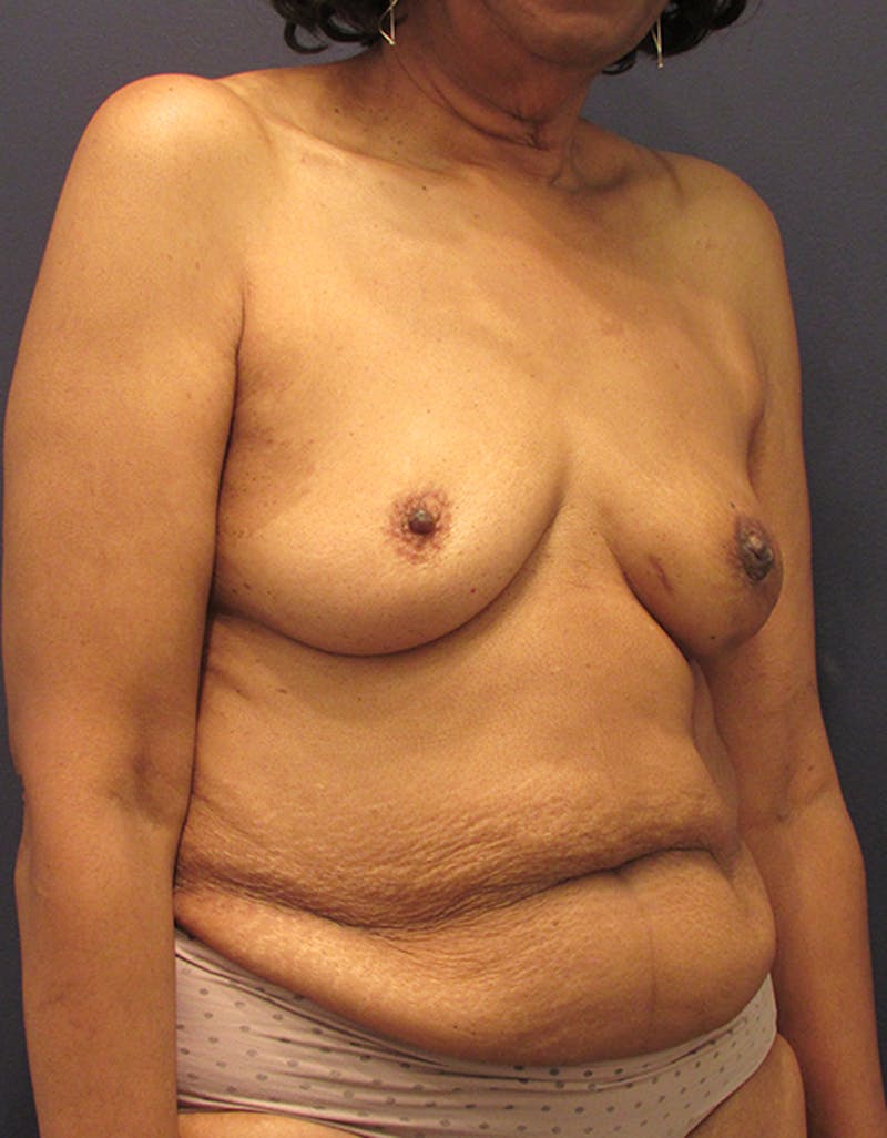 Breast Reconstruction Before & After Gallery - Patient 174164434 - Image 5