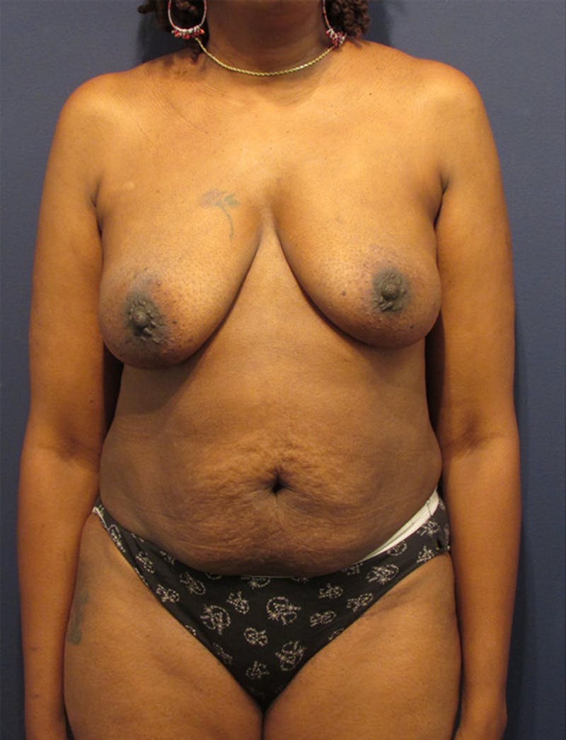 Breast Reconstruction Before & After Gallery - Patient 174164441 - Image 1