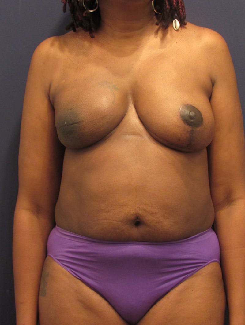 Breast Reconstruction Before & After Gallery - Patient 174164441 - Image 2