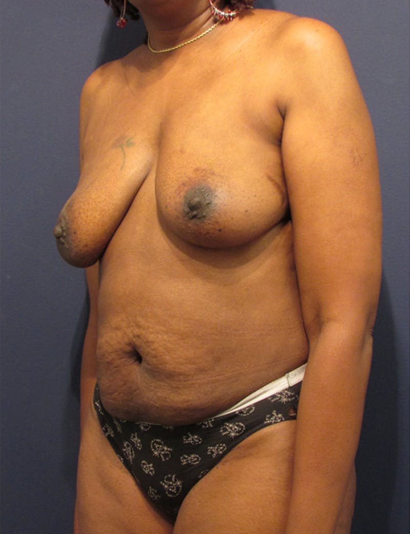 Breast Reconstruction Before & After Gallery - Patient 174164441 - Image 3