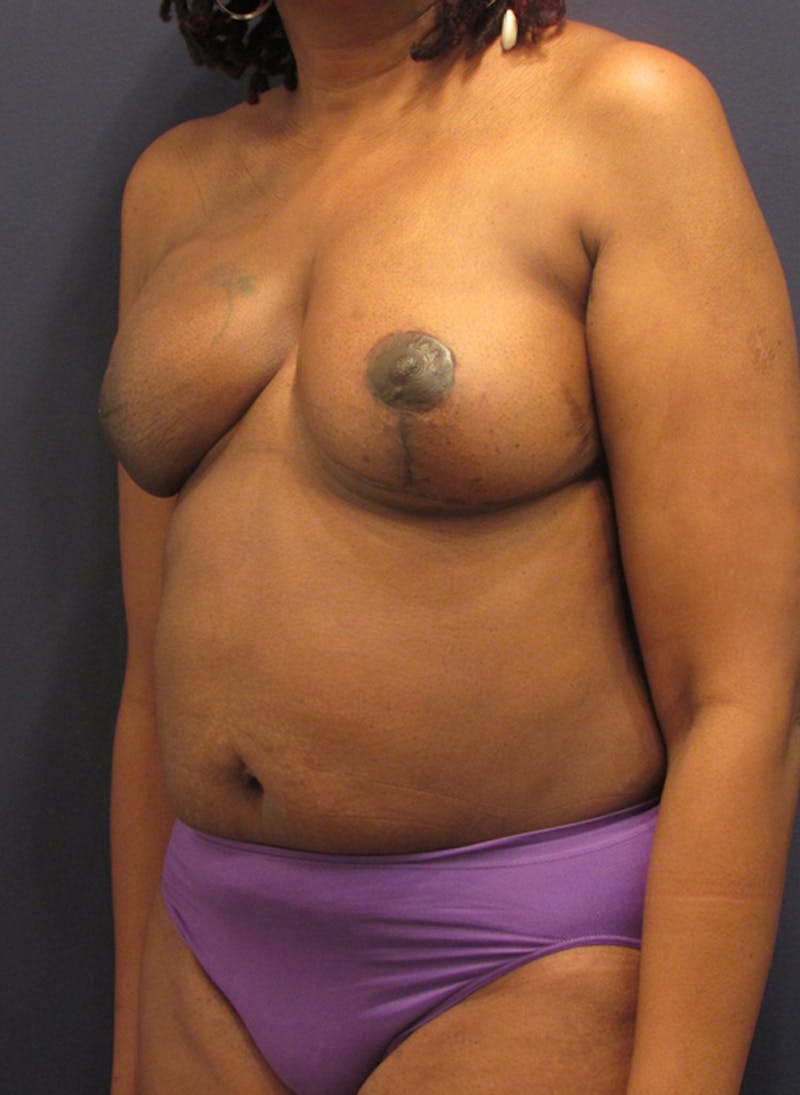 Breast Reconstruction Before & After Gallery - Patient 174164441 - Image 4