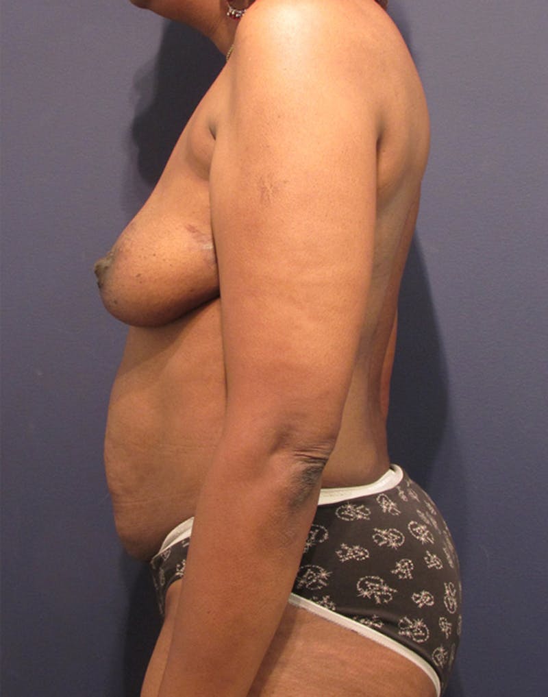 Breast Reconstruction Before & After Gallery - Patient 174164441 - Image 5