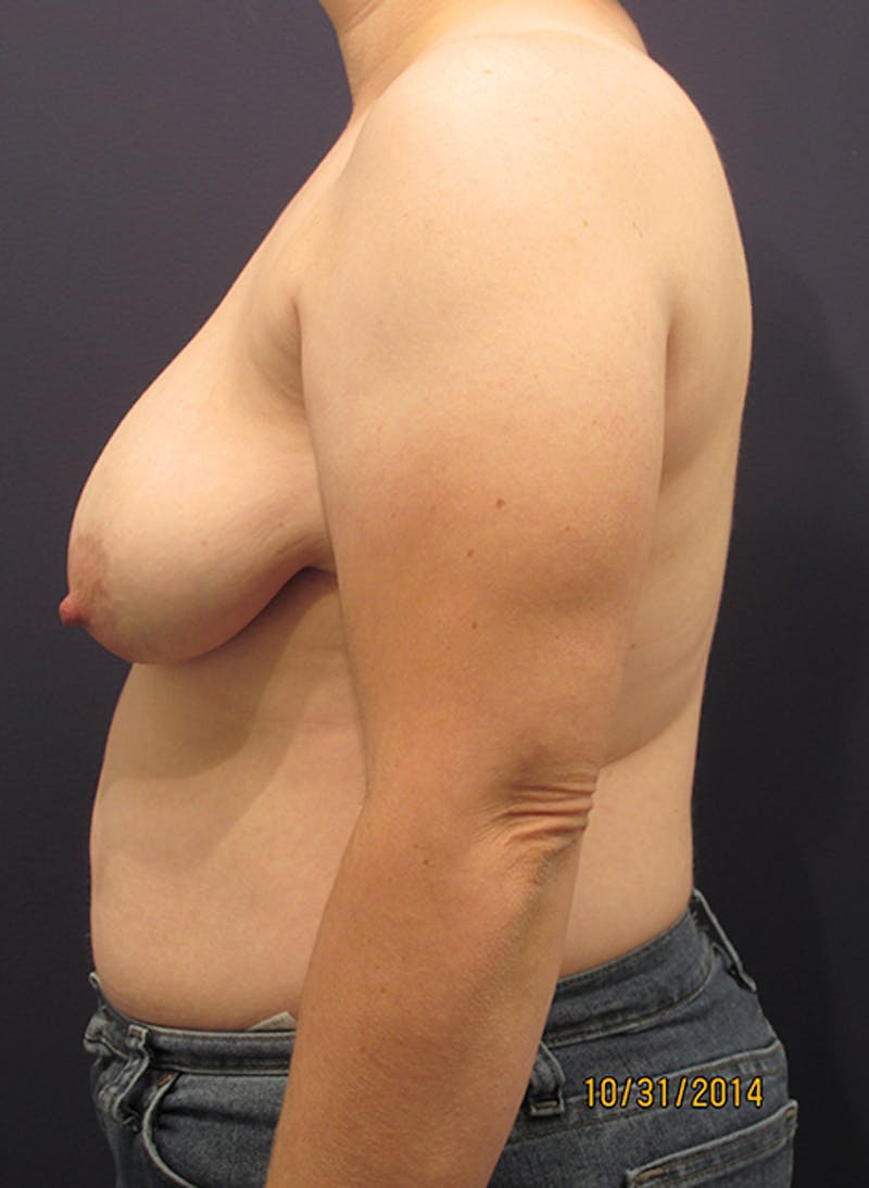 Breast Reconstruction Before & After Gallery - Patient 174164448 - Image 5