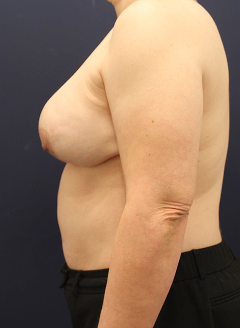 Breast Reconstruction Before & After Gallery - Patient 174164448 - Image 6