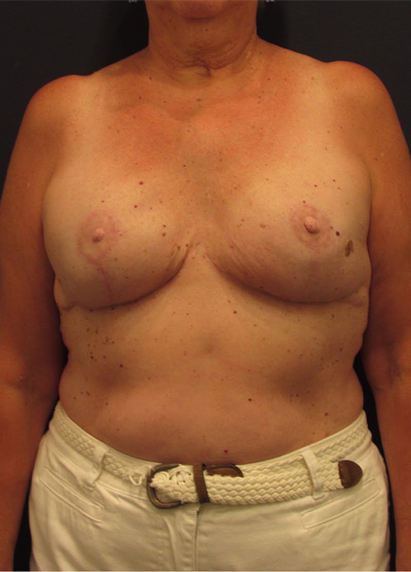 Breast Reconstruction Before & After Gallery - Patient 174164456 - Image 2