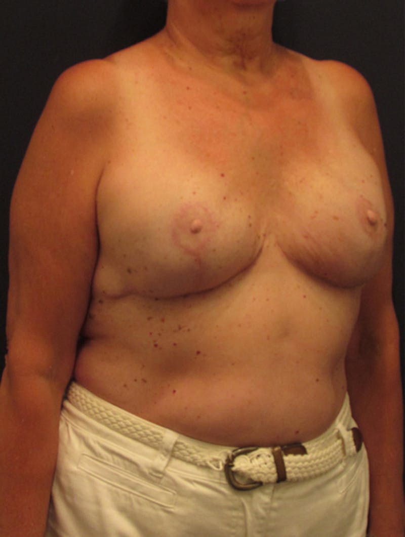Breast Reconstruction Before & After Gallery - Patient 174164456 - Image 4