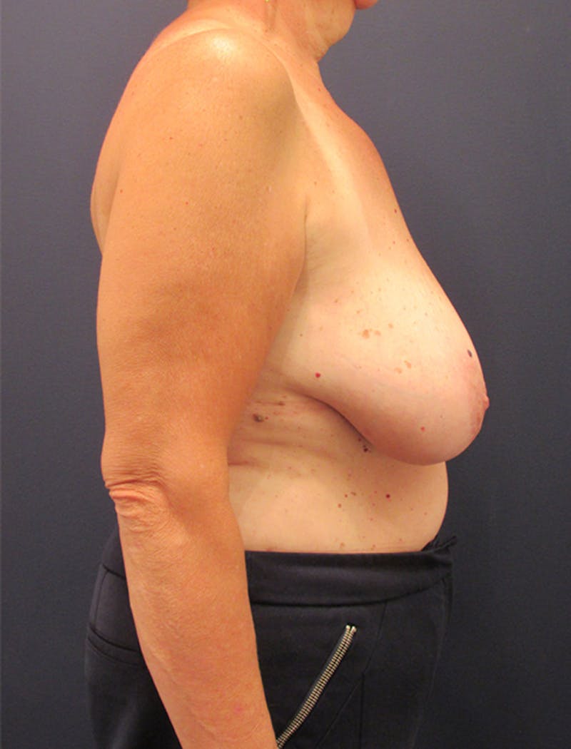 Breast Reconstruction Before & After Gallery - Patient 174164456 - Image 5