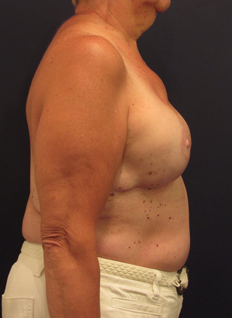 Breast Reconstruction Before & After Gallery - Patient 174164456 - Image 6