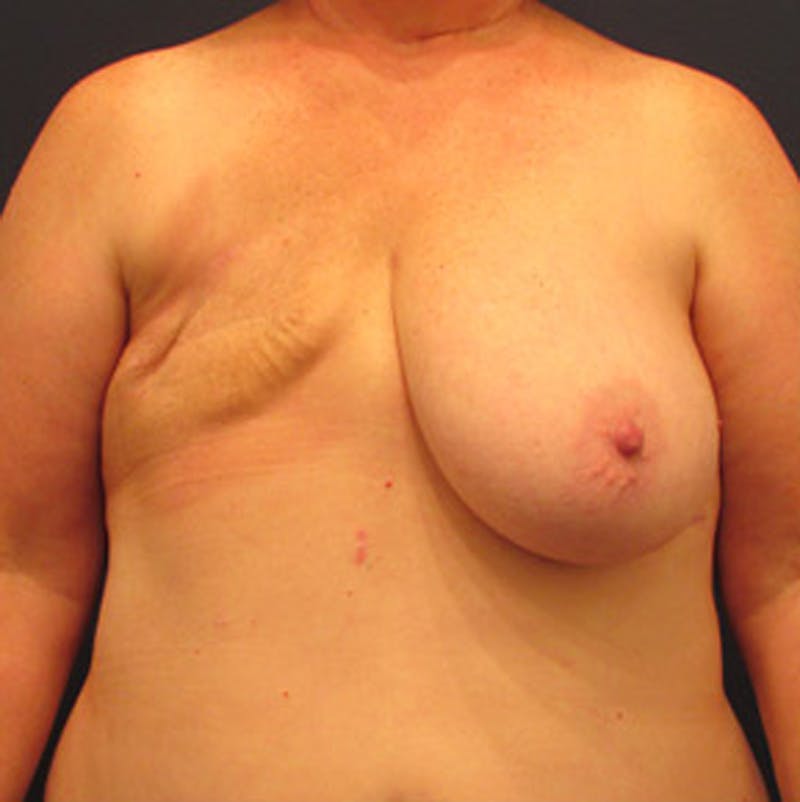 Breast Reconstruction Before & After Gallery - Patient 174164461 - Image 1