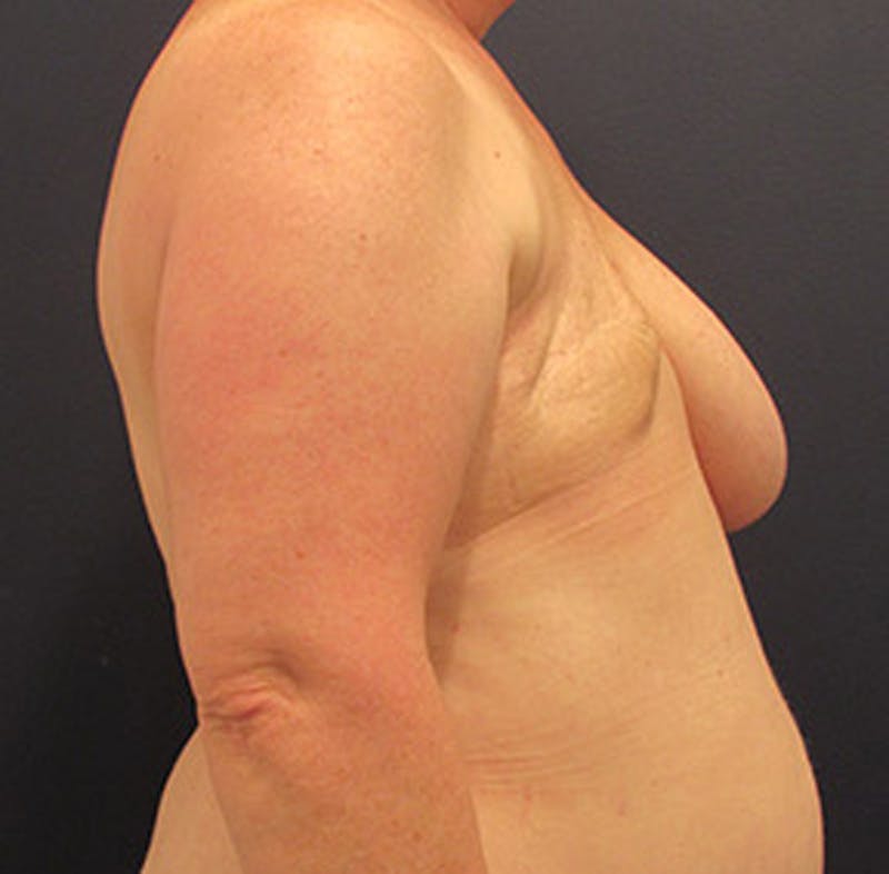 Breast Reconstruction Before & After Gallery - Patient 174164461 - Image 3