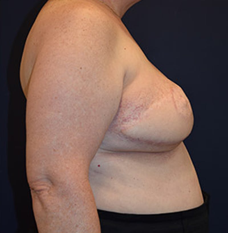 Breast Reconstruction Before & After Gallery - Patient 174164461 - Image 4