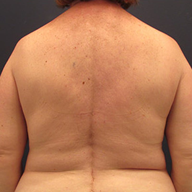 Breast Reconstruction Before & After Gallery - Patient 174164461 - Image 5