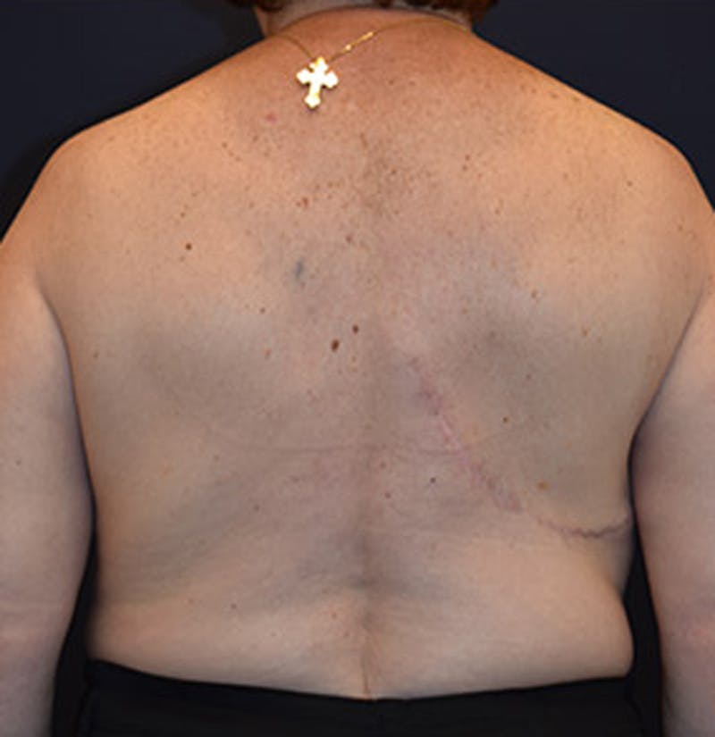 Breast Reconstruction Before & After Gallery - Patient 174164461 - Image 6