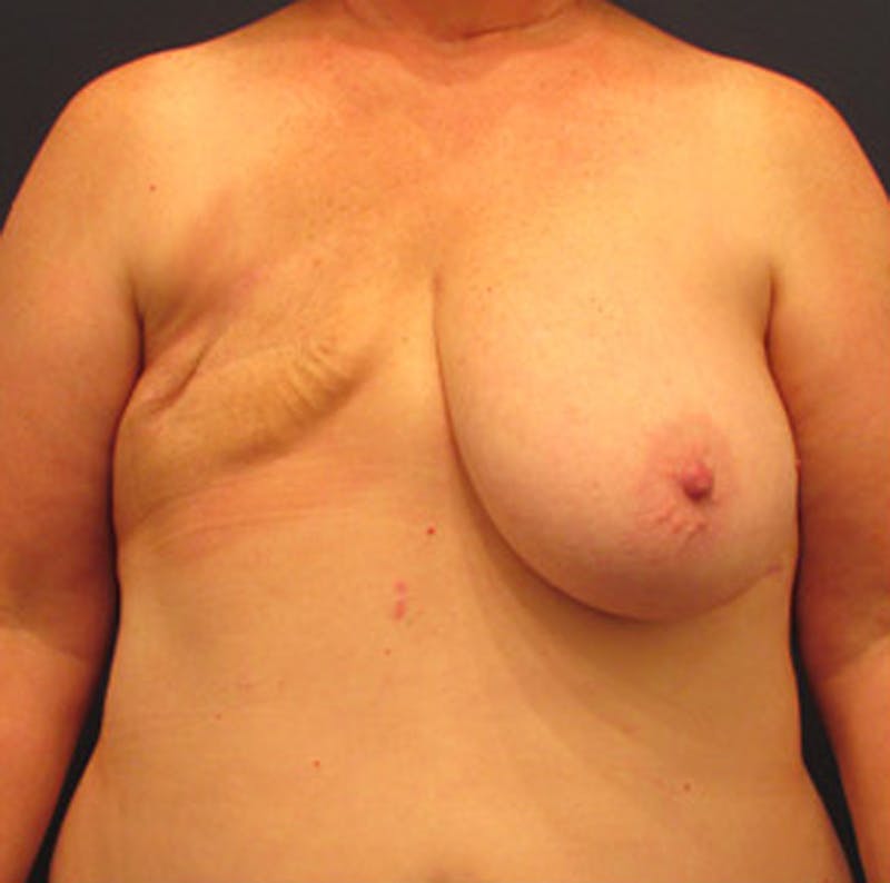 Breast Reconstruction Before & After Gallery - Patient 174164466 - Image 1