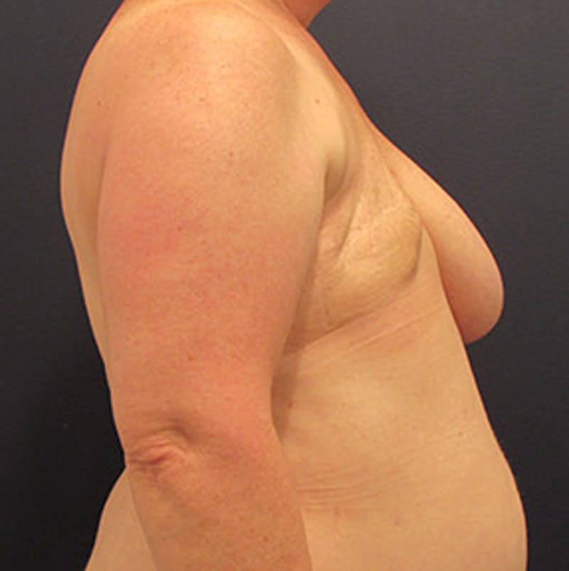 Breast Reconstruction Before & After Gallery - Patient 174164466 - Image 3