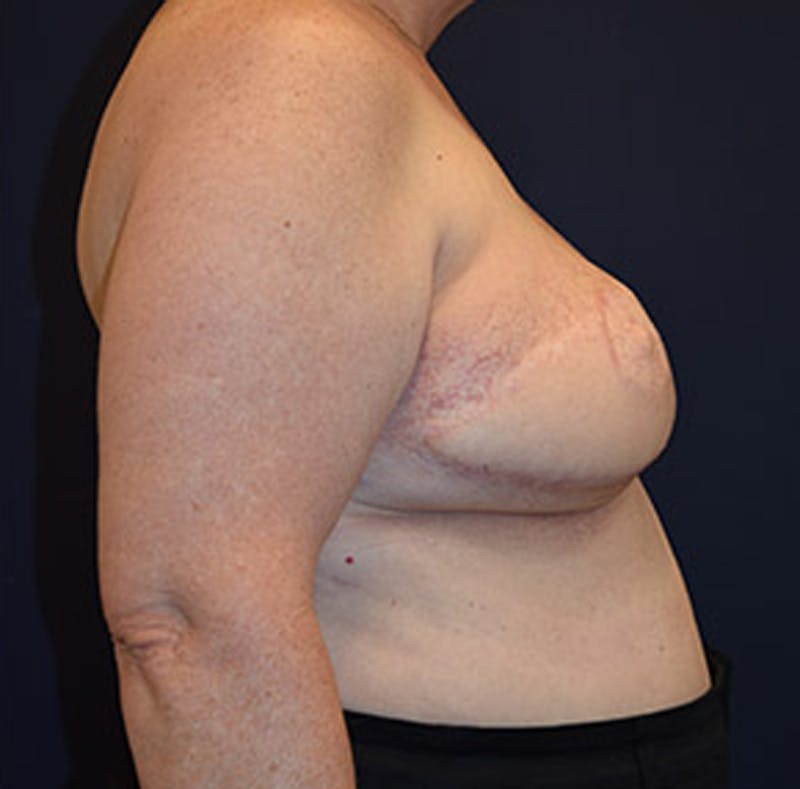 Breast Reconstruction Before & After Gallery - Patient 174164466 - Image 4
