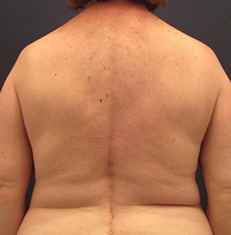 Breast Reconstruction Before & After Gallery - Patient 174164466 - Image 5