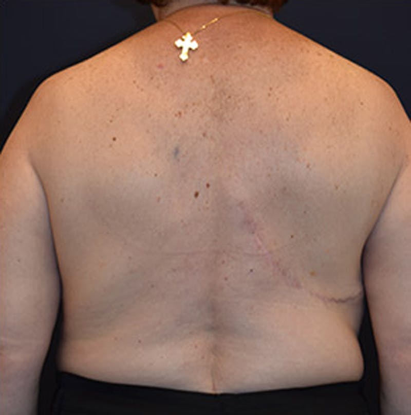Breast Reconstruction Before & After Gallery - Patient 174164466 - Image 6