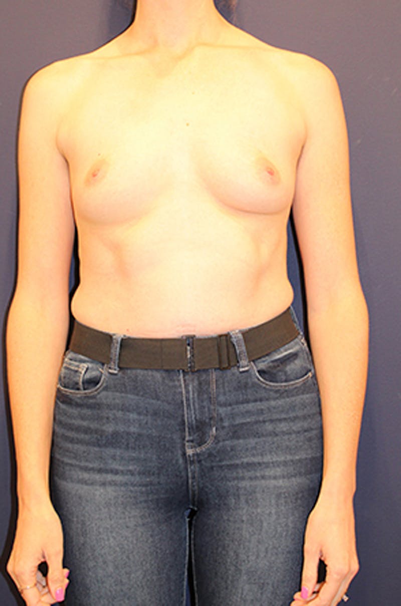 Breast Reconstruction Before & After Gallery - Patient 174164469 - Image 1