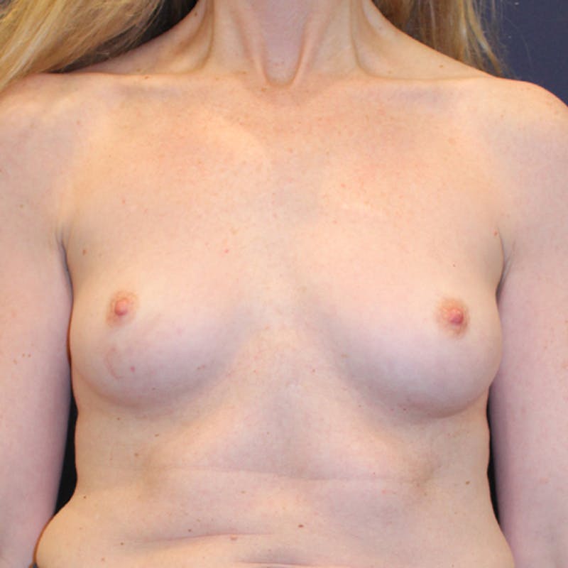 Breast Reconstruction Before & After Gallery - Patient 174164473 - Image 1