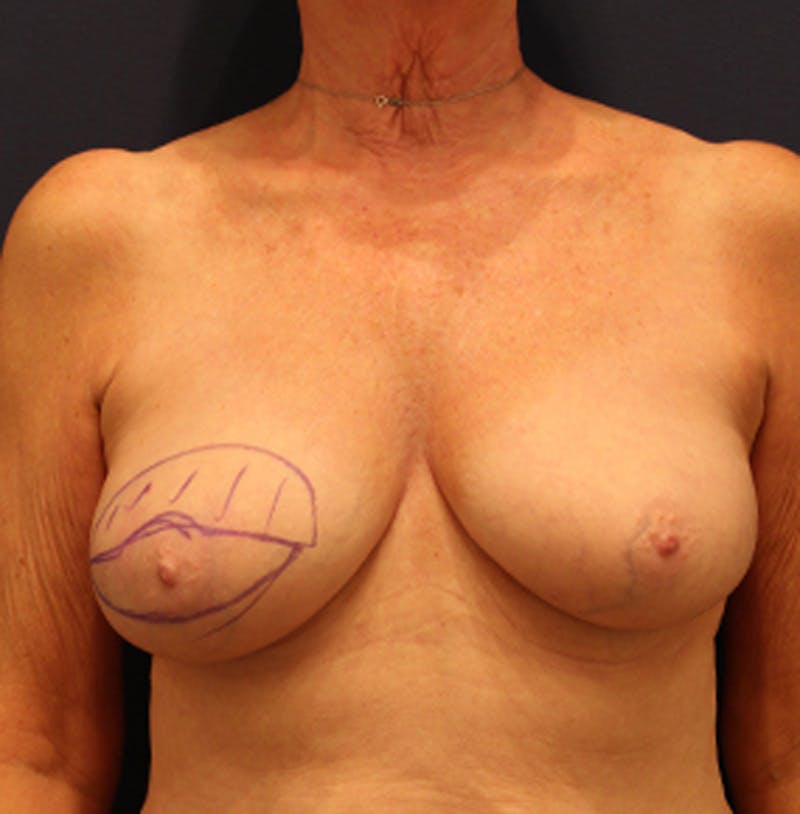 Breast Reconstruction Before & After Gallery - Patient 174164483 - Image 1