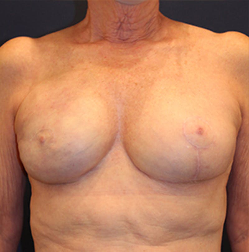 Breast Reconstruction Before & After Gallery - Patient 174164483 - Image 2