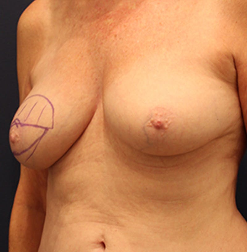 Breast Reconstruction Before & After Gallery - Patient 174164483 - Image 3
