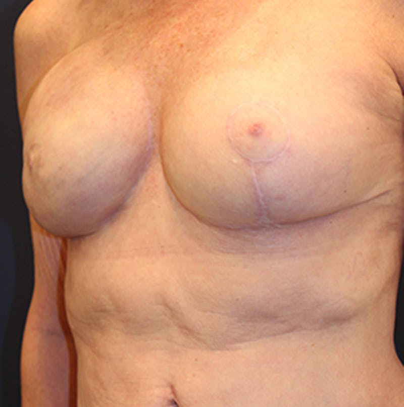 Breast Reconstruction Before & After Gallery - Patient 174164483 - Image 4