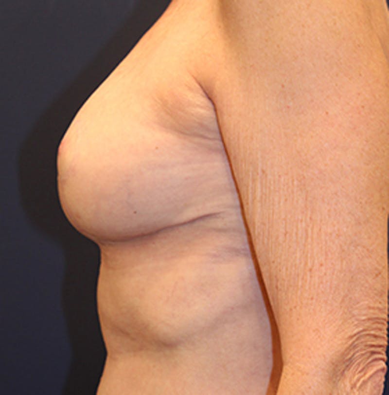 Breast Reconstruction Before & After Gallery - Patient 174164483 - Image 6