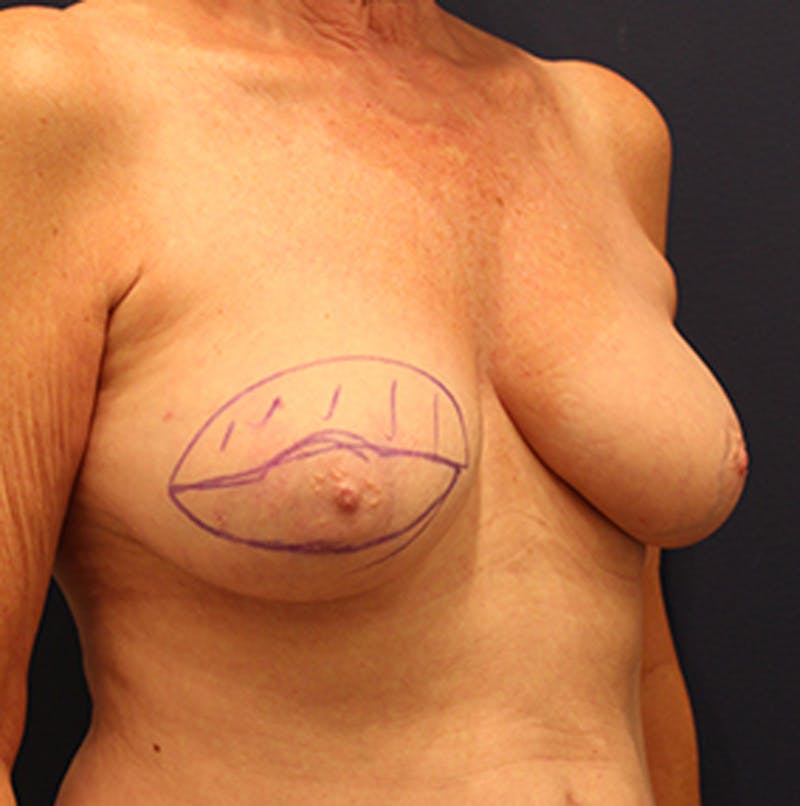 Breast Reconstruction Before & After Gallery - Patient 174164483 - Image 7