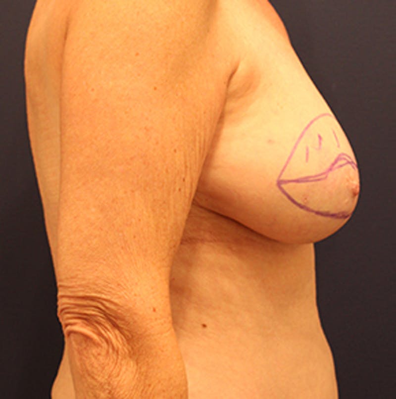 Breast Reconstruction Before & After Gallery - Patient 174164483 - Image 9