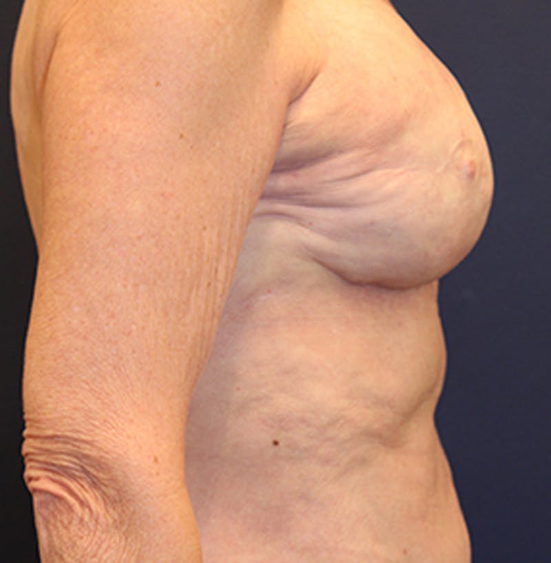 Breast Reconstruction Before & After Gallery - Patient 174164483 - Image 10