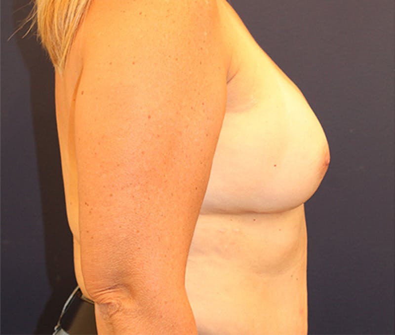 Breast Reconstruction Before & After Gallery - Patient 174164494 - Image 5