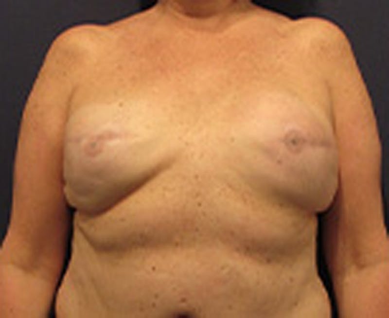 Breast Reconstruction Before & After Gallery - Patient 174164497 - Image 1