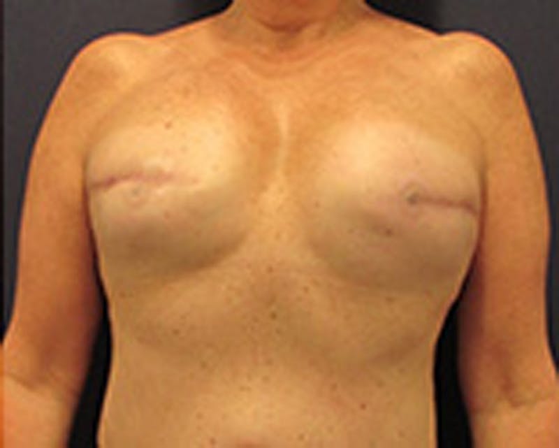 Breast Reconstruction Before & After Gallery - Patient 174164497 - Image 2