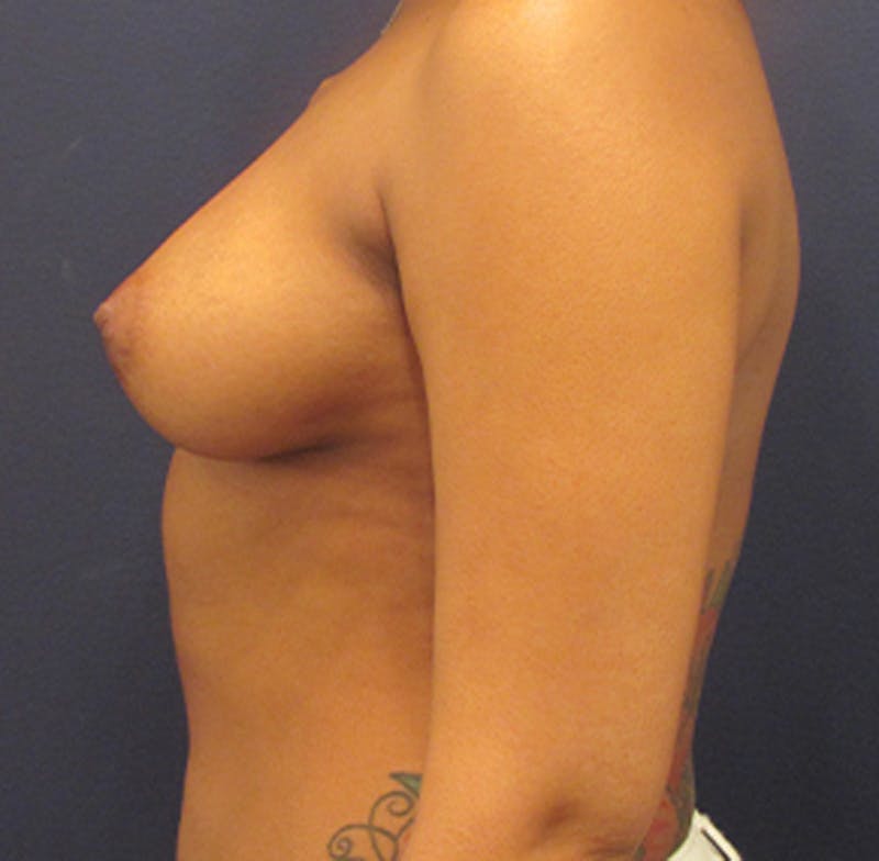 Breast Reconstruction Before & After Gallery - Patient 174164505 - Image 5