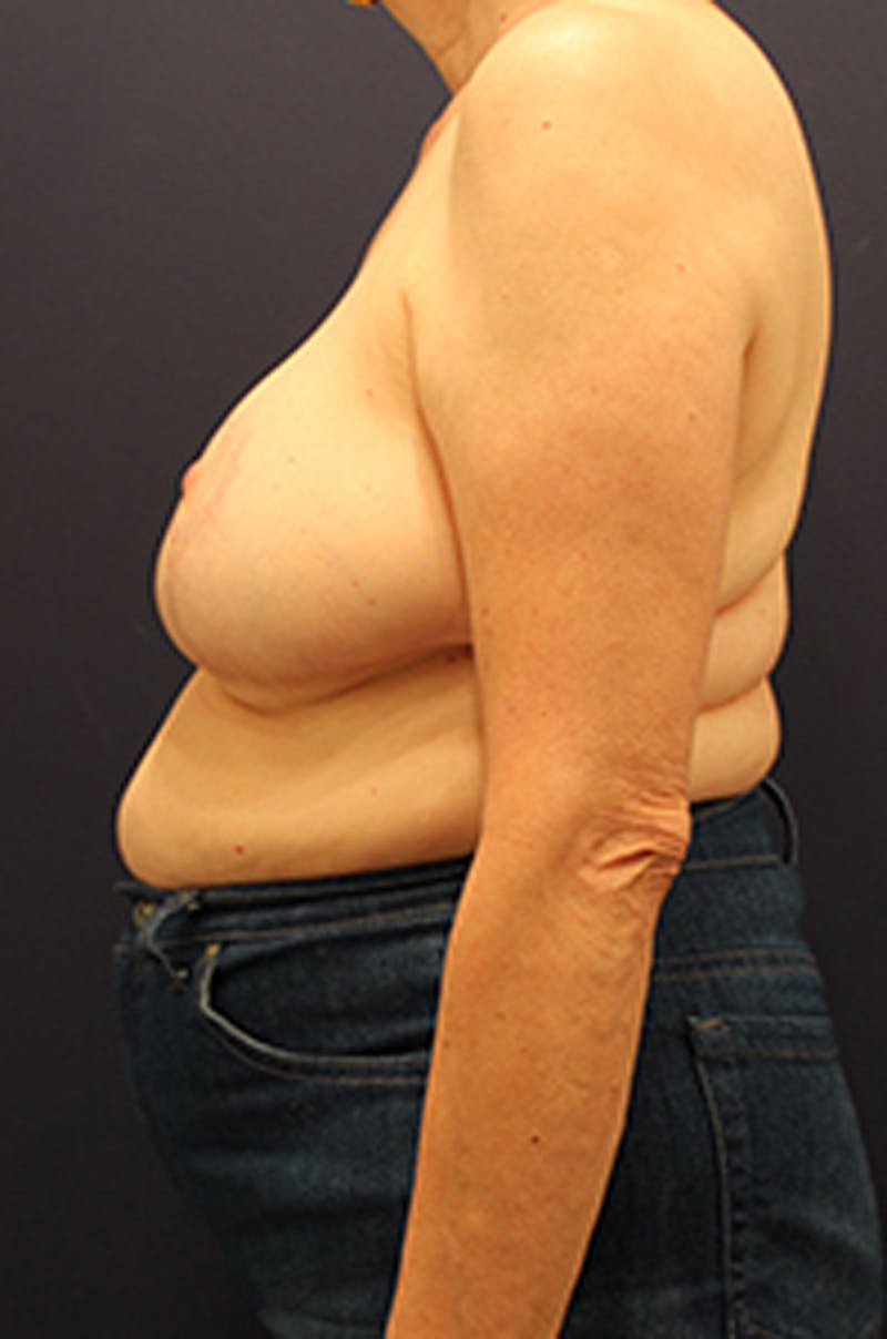 Breast Reduction Before & After Gallery - Patient 174148867 - Image 6