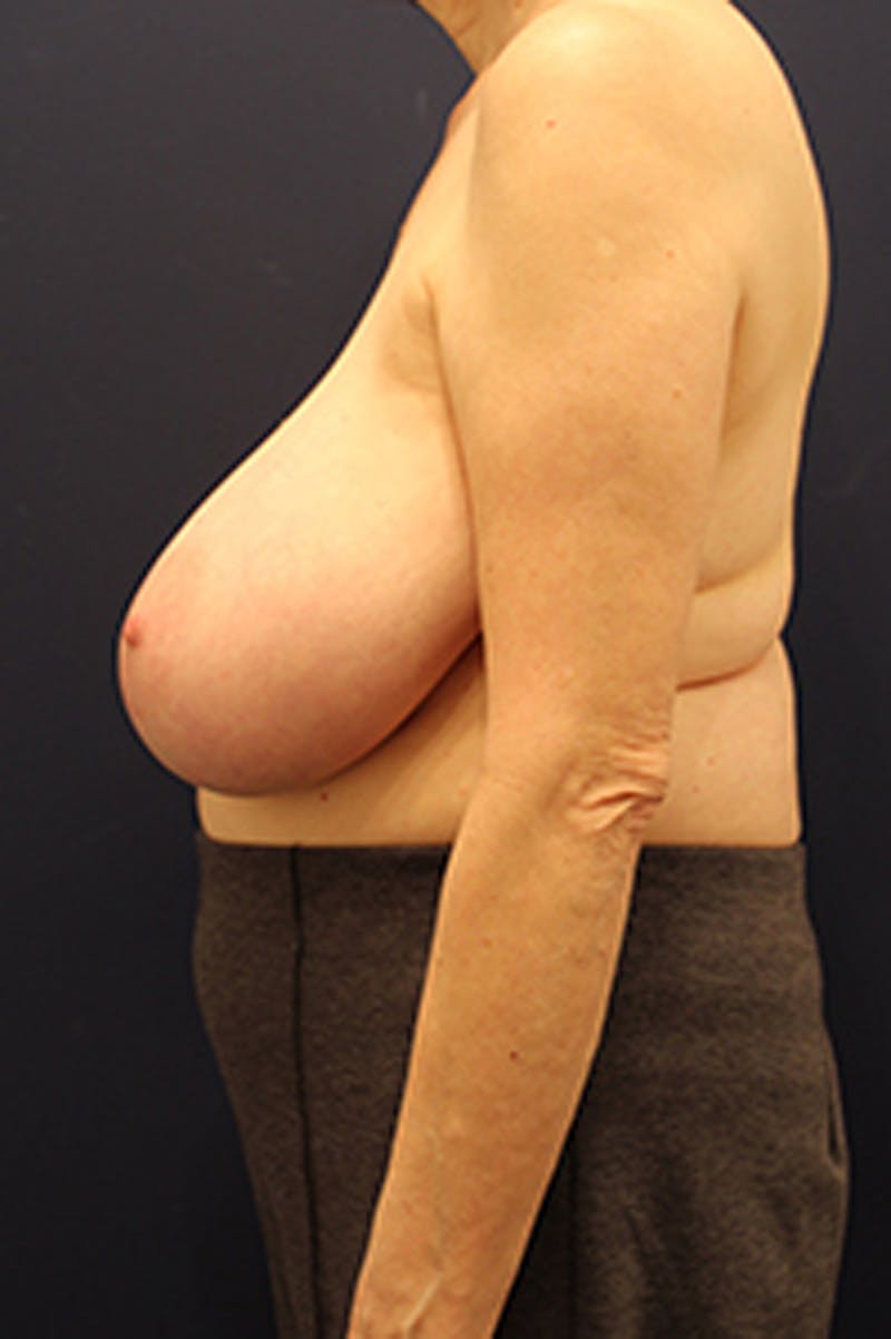 Breast Reduction Before & After Gallery - Patient 174148867 - Image 5