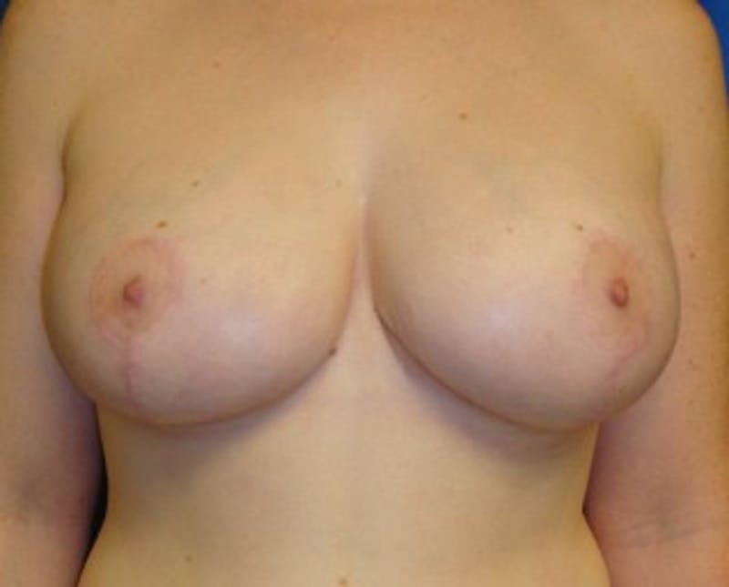 Breast Reduction Before & After Gallery - Patient 174148873 - Image 2