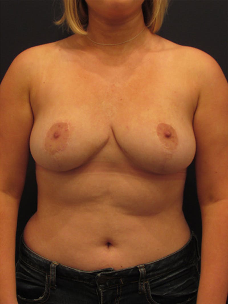 Breast Reduction Before & After Gallery - Patient 174148883 - Image 2