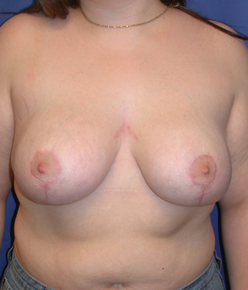 Breast Reduction Before & After Gallery - Patient 174149964 - Image 2